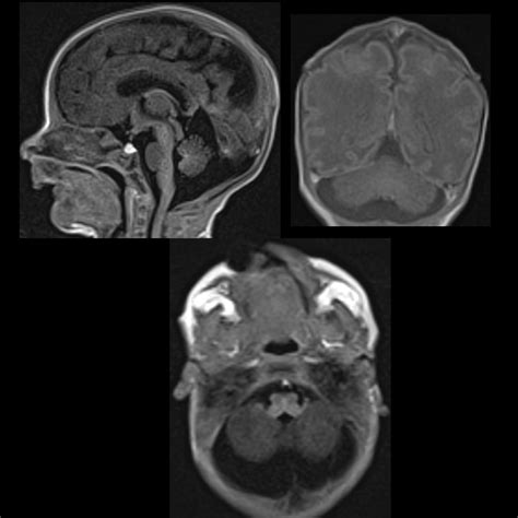 mega sisterna magna|Mega Cisterna Magna: Understanding an Enlarged Cisterna .